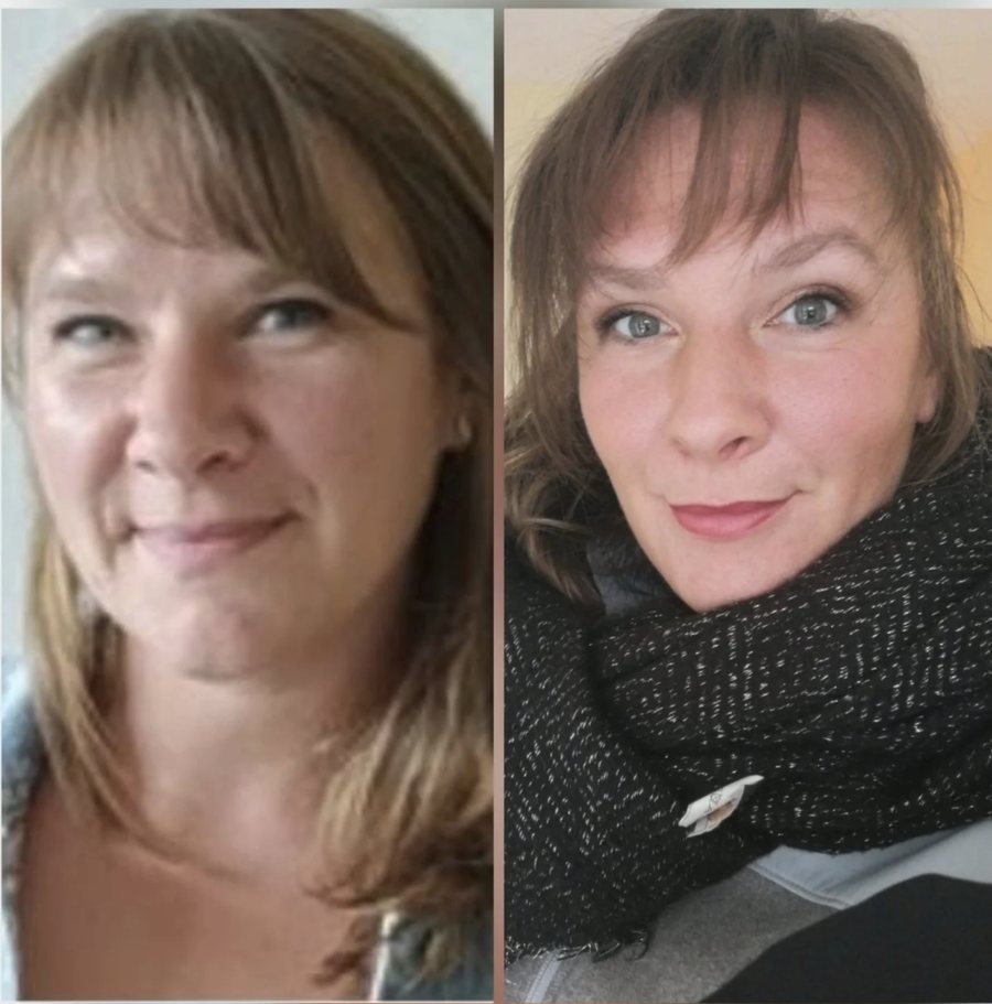 Avant / après du visage affiné après un rééquilibrage alimentaire accompagné