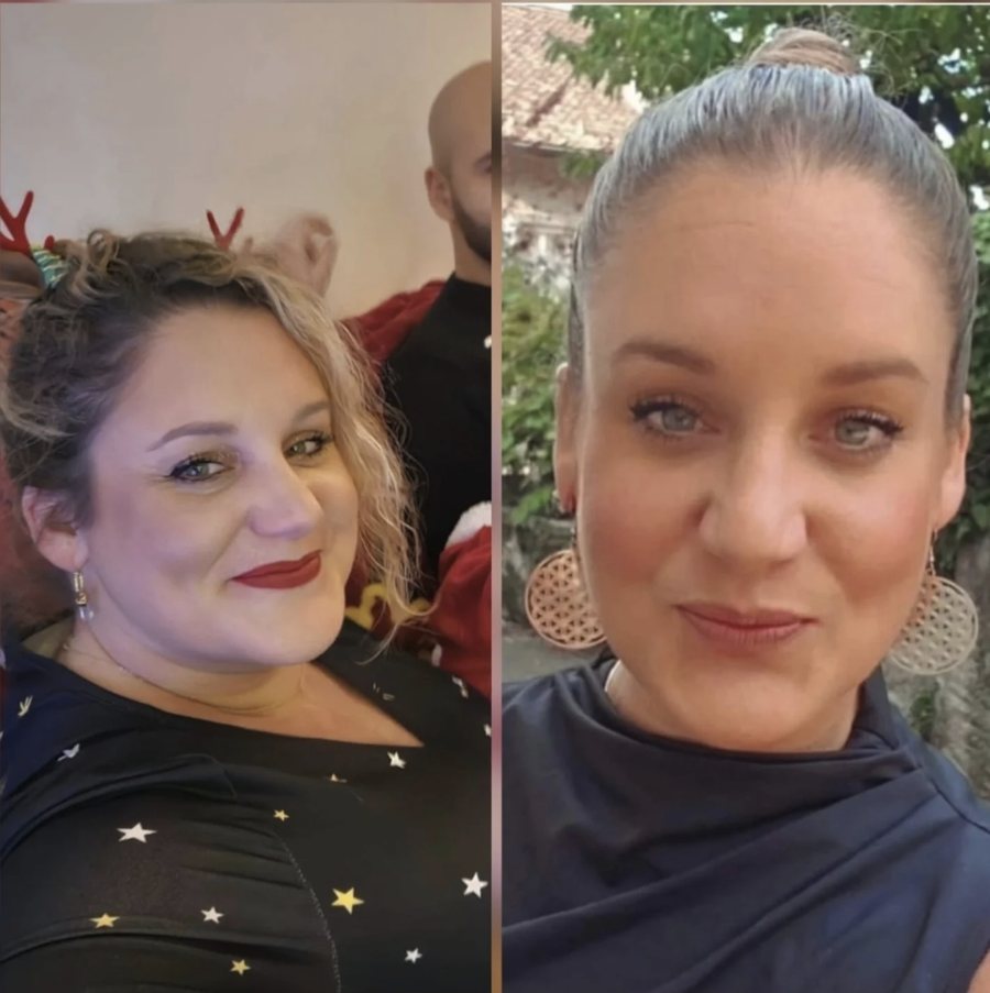 Avant / après du visage d'une cliente après une perte de poids accompagnée